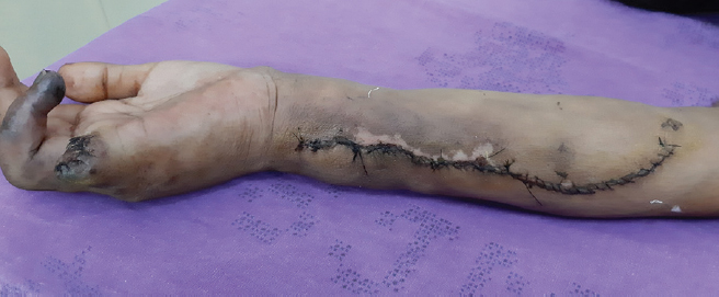 Post-debulking and amputation of little finger image of the right forearm showing significant reduction in the size of the AVMs.